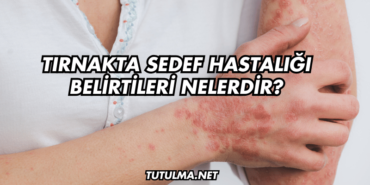 Tırnakta Sedef Hastalığı Belirtileri Nelerdir?