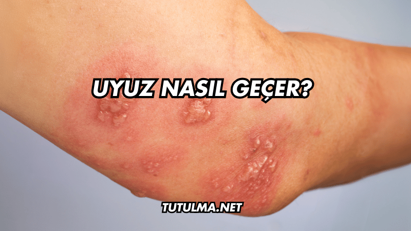 Uyuz Nasıl Geçer?