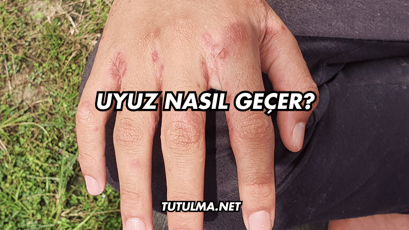 Uyuz Nasıl Geçer?